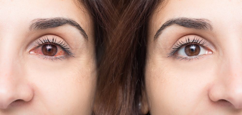 6 Easy Lifestyle Tips for Soothing Dry Eyes