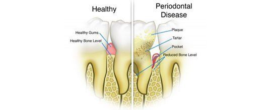 Periodontal Disease Diagram