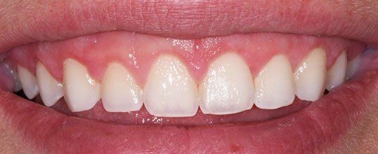 gum grafting benefits
