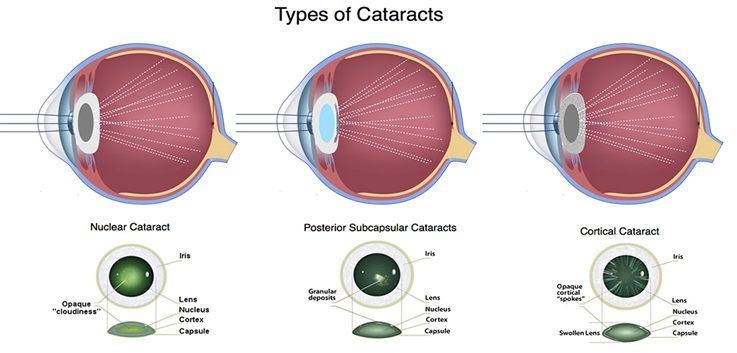 diagram of types of cataracts