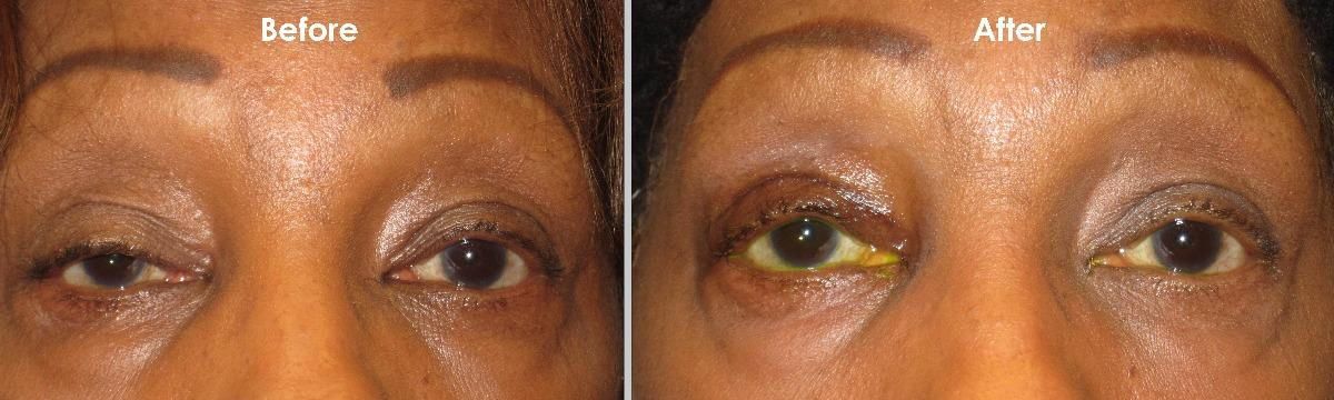  Ptosis: What Is It and How We Fix It