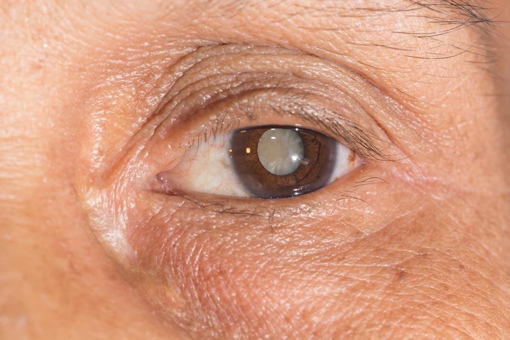 6 Signs You Might Have Eye Cataracts
