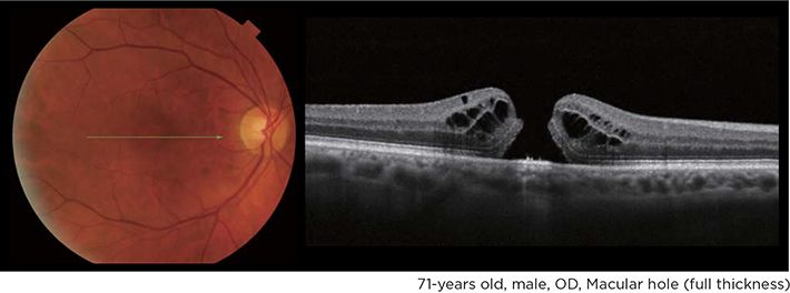 macular hole