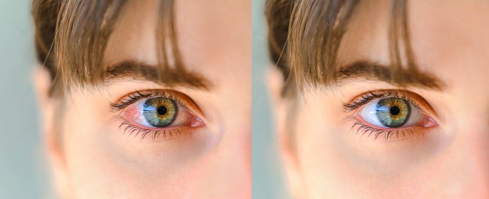 3 Symptoms of Pink Eye and How to Treat It