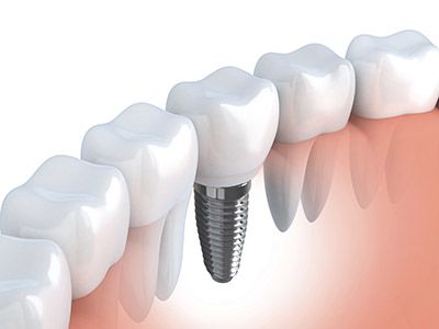 DENTIST IN THE LAS VEGAS AREA FOR THE PLACEMENT AND RESTORATION OF IMPLANTS