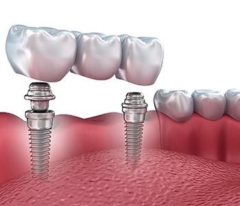 DO YOU NEED A DENTAL IMPLANT OR A CROWN IN LAS VEGAS, NV?