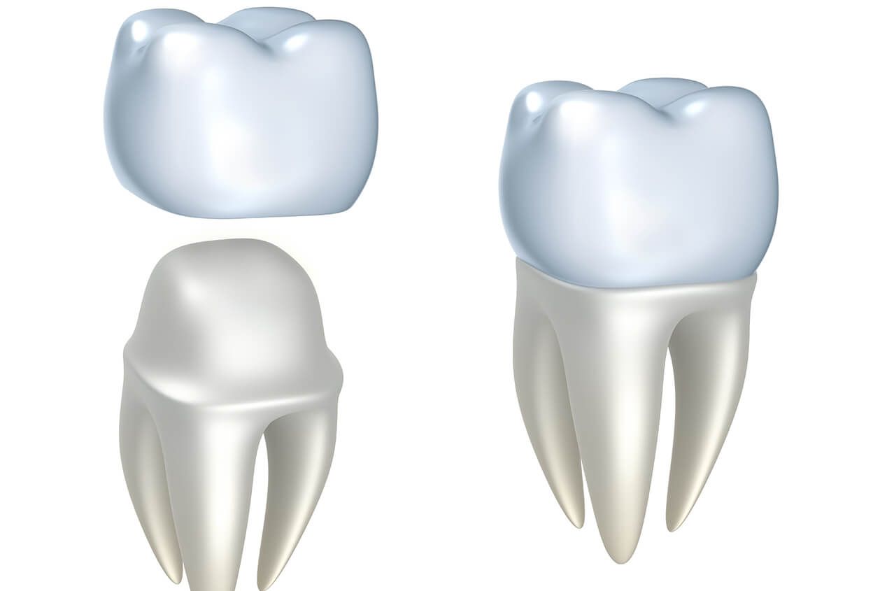 TYPES OF DENTAL CROWNS AND THE PURPOSE OF CROWNS