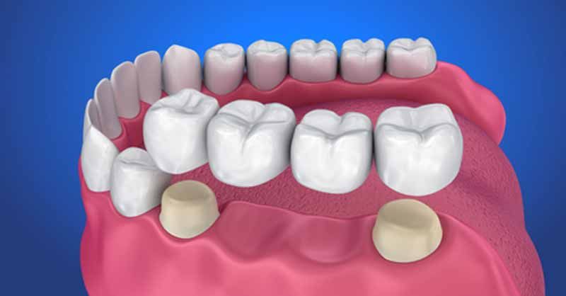 LAS VEGAS, NV DENTIST HELPS DEMYSTIFY THE TYPES OF DENTAL CROWNS AVAILABLE
