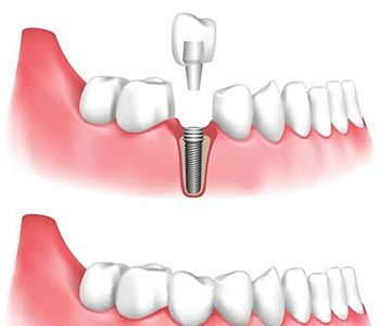 WHAT ARE THE REASONS TO FIND DENTAL IMPLANT TREATMENT NEAR ME IN LAS VEGAS?