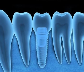 SURGERY FOR THE PLACEMENT OF DENTAL IMPLANTS IS AVAILABLE IN LAS VEGAS, NV