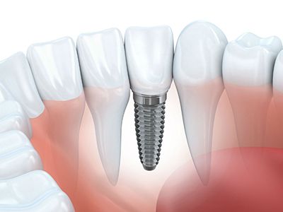 LAS VEGAS AREA DENTIST MAY SUGGEST DENTAL IMPLANTS FOR STABILIZING DENTURES