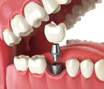 WHAT IS THE COST OF MISSING TEETH REPLACEMENT WITH DENTAL IMPLANTS IN LAS VEGAS, NEVADA?