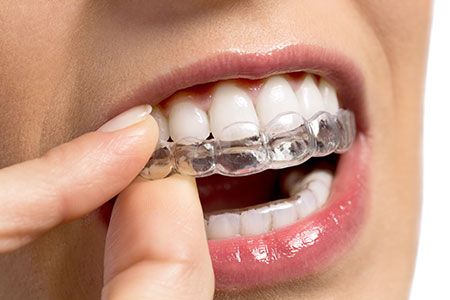 INVISALIGN IS AVAILABLE TO PATIENTS AT LAS VEGAS DENTAL PRACTICE