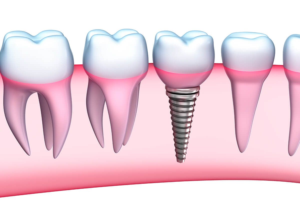 DENTIST IN LAS VEGAS, NV DESCRIBES ALTERNATIVES TO SERVICES SUCH AS THE PLACEMENT OF DENTAL IMPLANTS