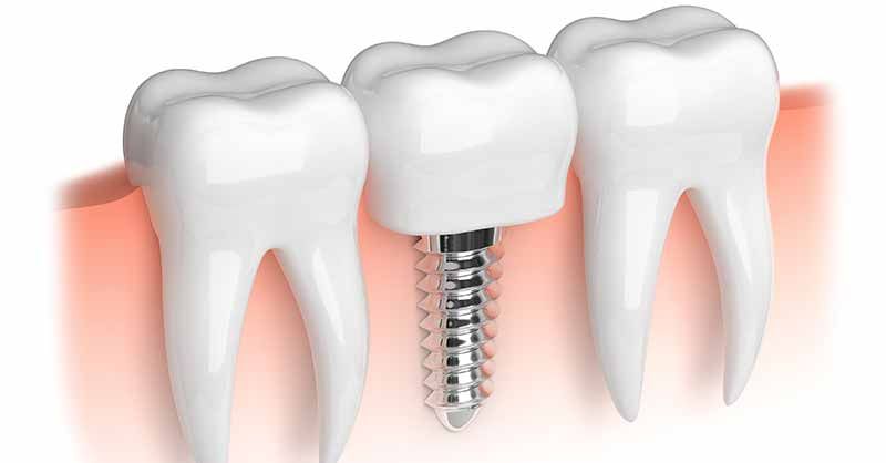 LAS VEGAS DENTIST GIVES AREA PATIENTS TIPS FOR SUCCESSFUL DENTAL IMPLANTS TREATMENT