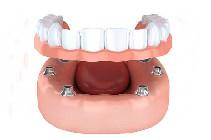 IMPLANT DENTISTS IN LAS VEGAS, NV HAVE OUTSTANDING OPTIONS FOR TOOTH REPLACEMENT