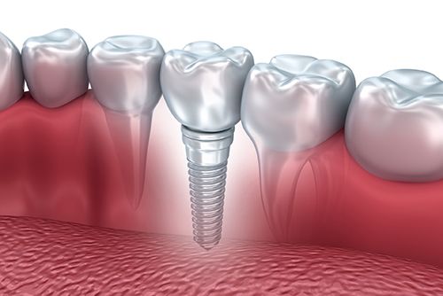 LAS VEGAS, NV AREA PATIENTS CAN REPLACE MISSING TEETH WITH ONE OR MORE DENTAL IMPLANTS