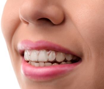 WHAT ARE THE BENEFITS OF INVISALIGN BRACES FOR LAS VEGAS AREA PATIENTS?