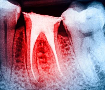 TREATING INFECTION OF A TOOTH WITH ROOT CANAL TREATMENT IN LAS VEGAS, NV