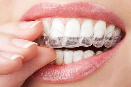 LAS VEGAS, NV PATIENTS ASK ABOUT THE COST OF INVISALIGN TREATMENT