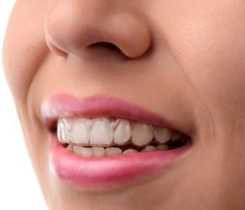 INVISALIGN: DISCREET TEETH ALIGNMENT FOR LAS VEGAS PATIENTS