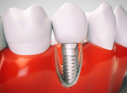 TITANIUM IMPLANTS IN LAS VEGAS, NV CAN RESTORE THE SMILE