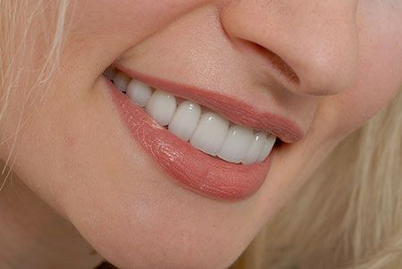 HOW CAN DENTISTS AROUND LAS VEGAS KNOW IF A DENTISTRY SERVICE LIKE VENEERS COULD BE RIGHT FOR ME?