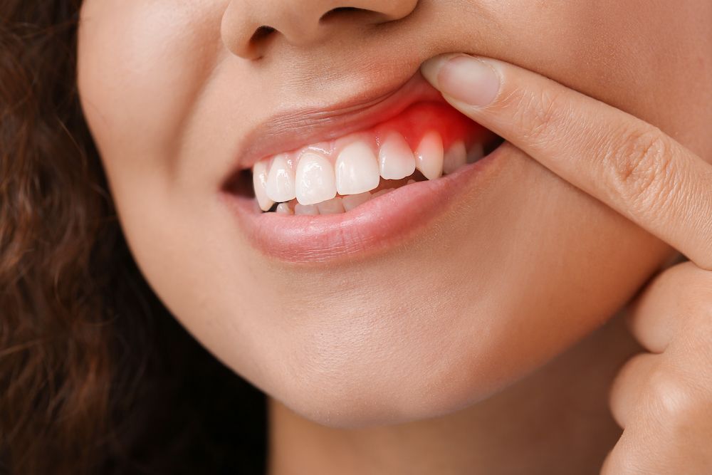 Stages of Gum Disease (Periodontitis)
