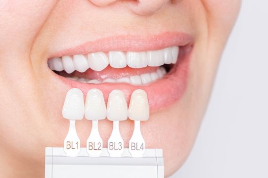 Types of Veneers and Which Is Right for You