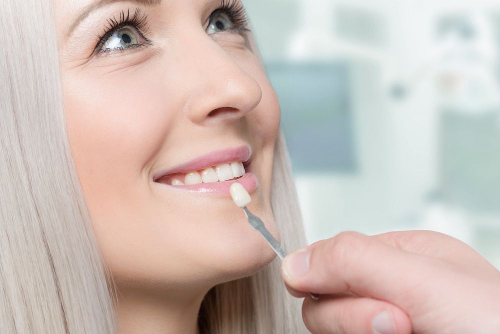 Are Dental Veneers Permanent?