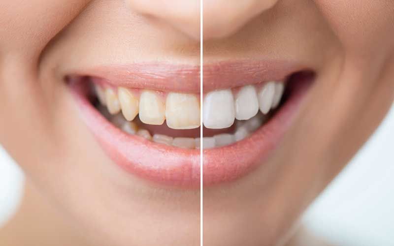 Teeth Whitening