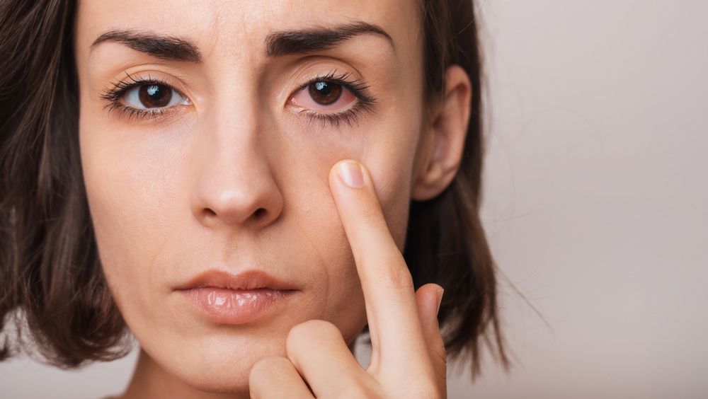 Red Eyes and Contact Lenses: How to Avoid Irritation and Infection