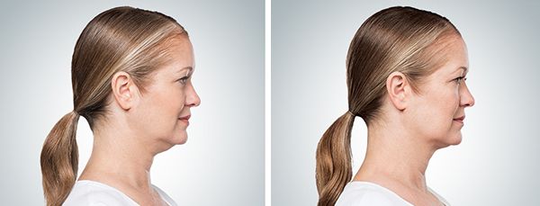 woman before and after kybella