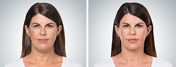 before and after kybella