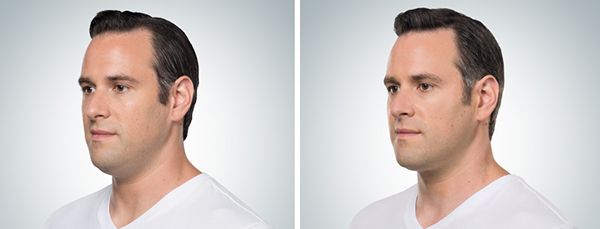 before and after kybella