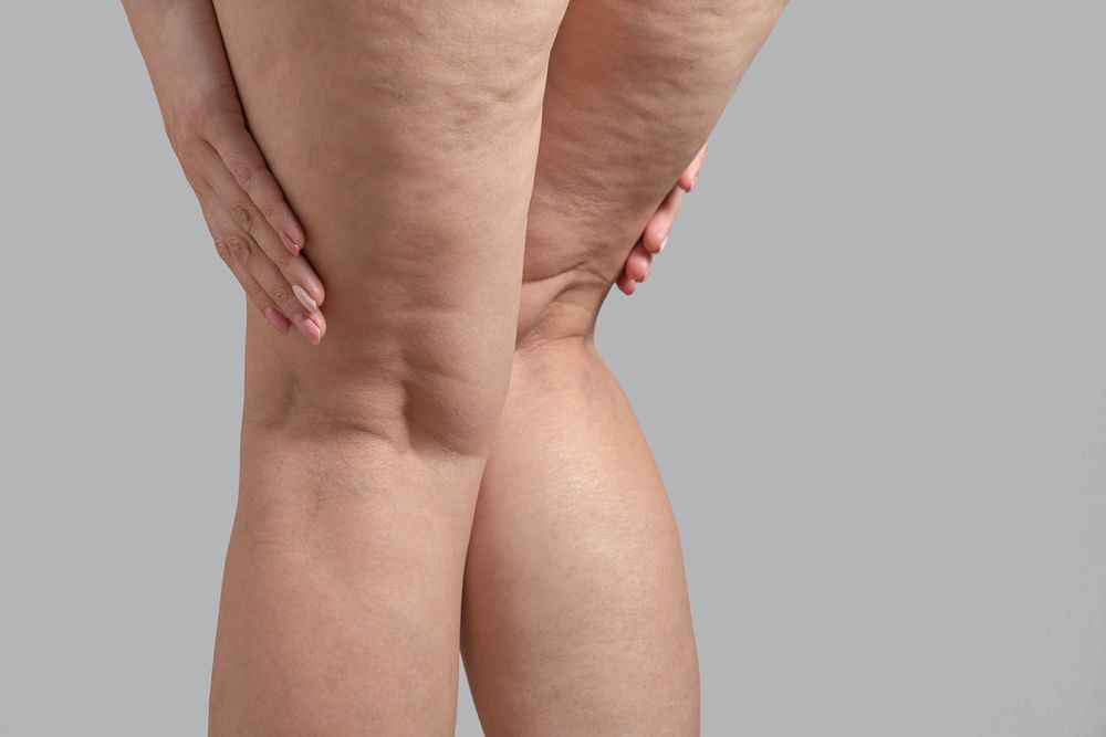 Cellulite on legs