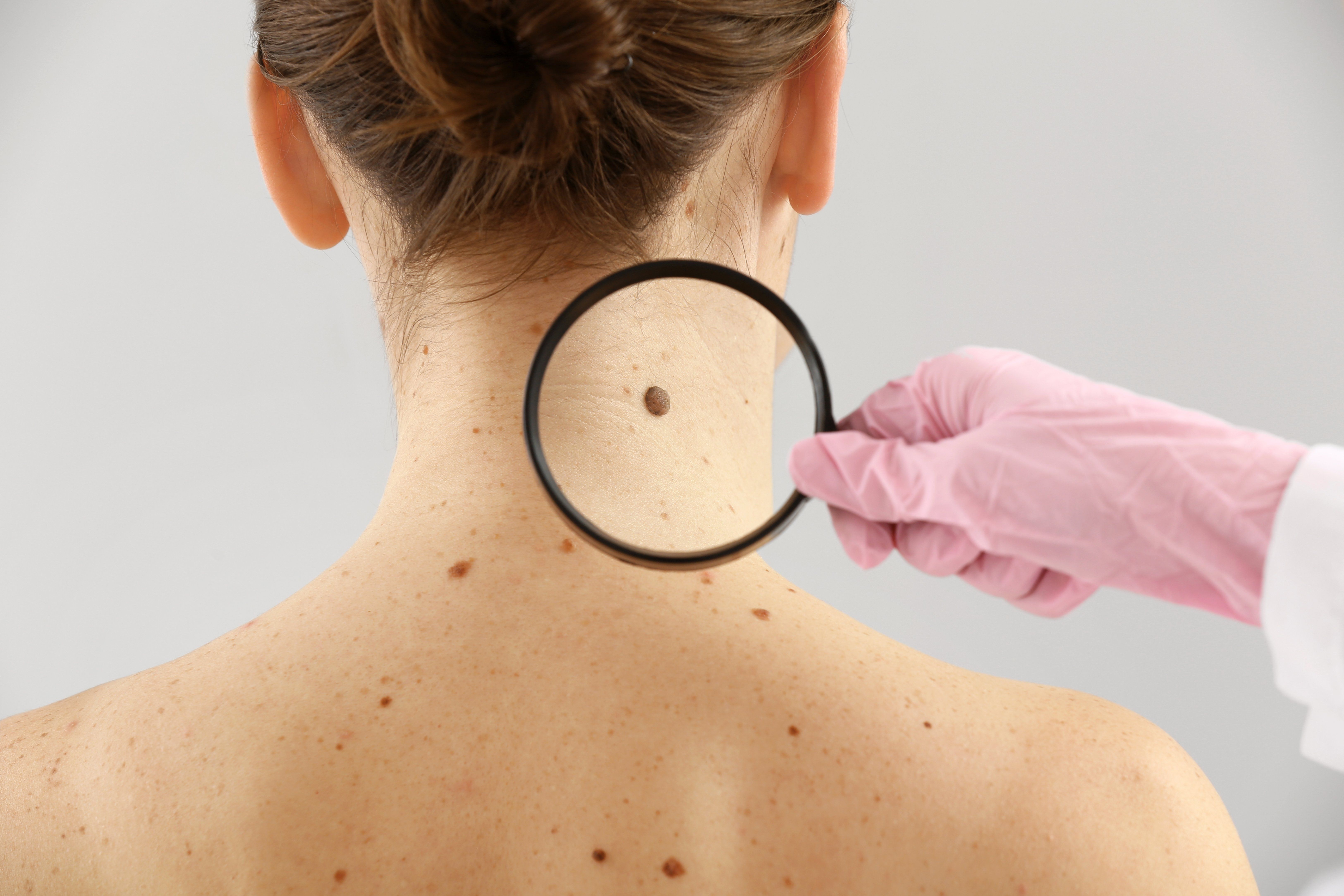 what to know about mole removal