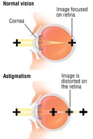 Astigmatism 3