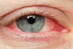 Eye Allergies 2