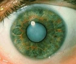 Cataracts 5
