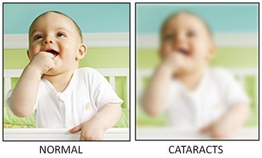 Cataracts 4