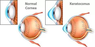 Keratoconus Treatments