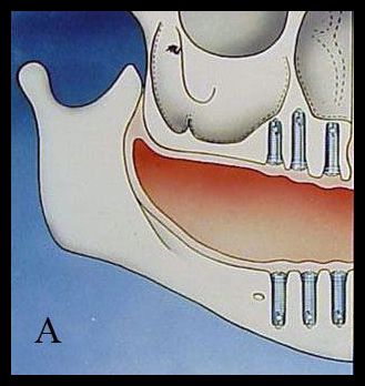 Sinus bone graft - A