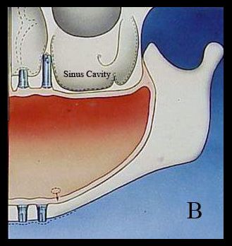 Sinus bone graft - B