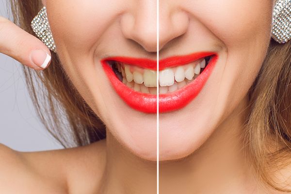 woman's smile before and after teeth whitening