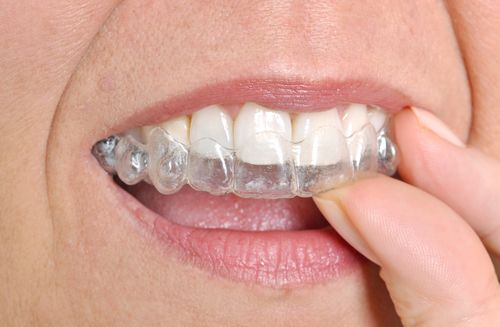 woman wearing invisalign