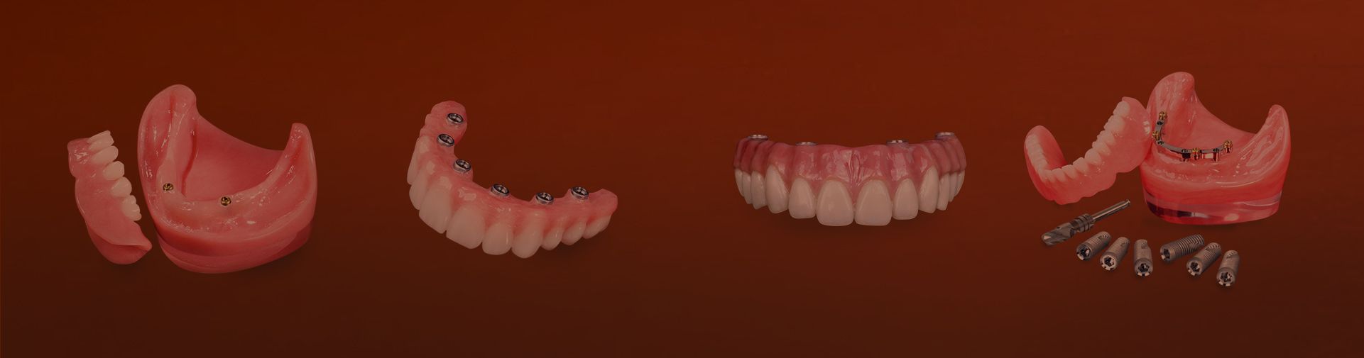 types of implant dentures