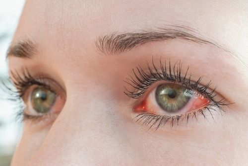 The Role of Artificial Tears in Managing Chronic Dry Eye