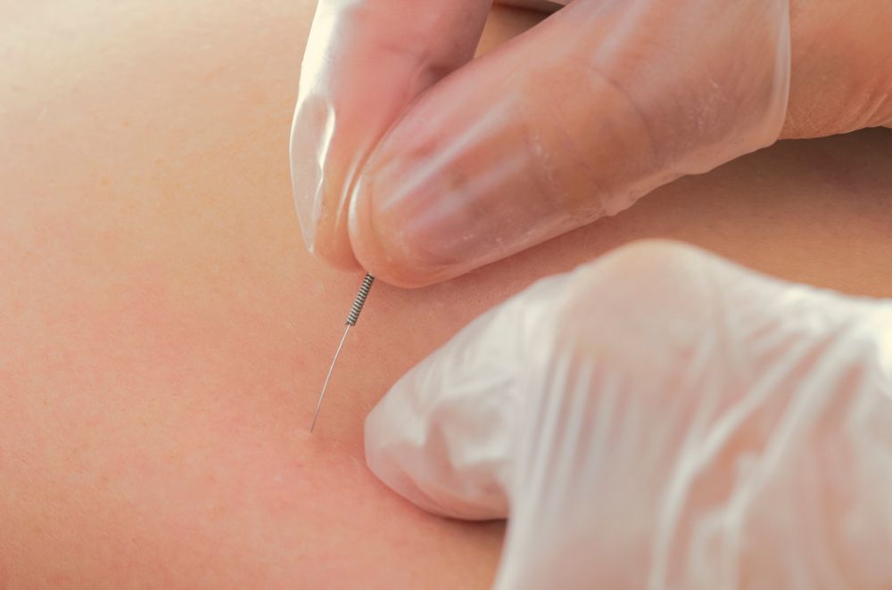 What Conditions Does Dry Needling Treat?