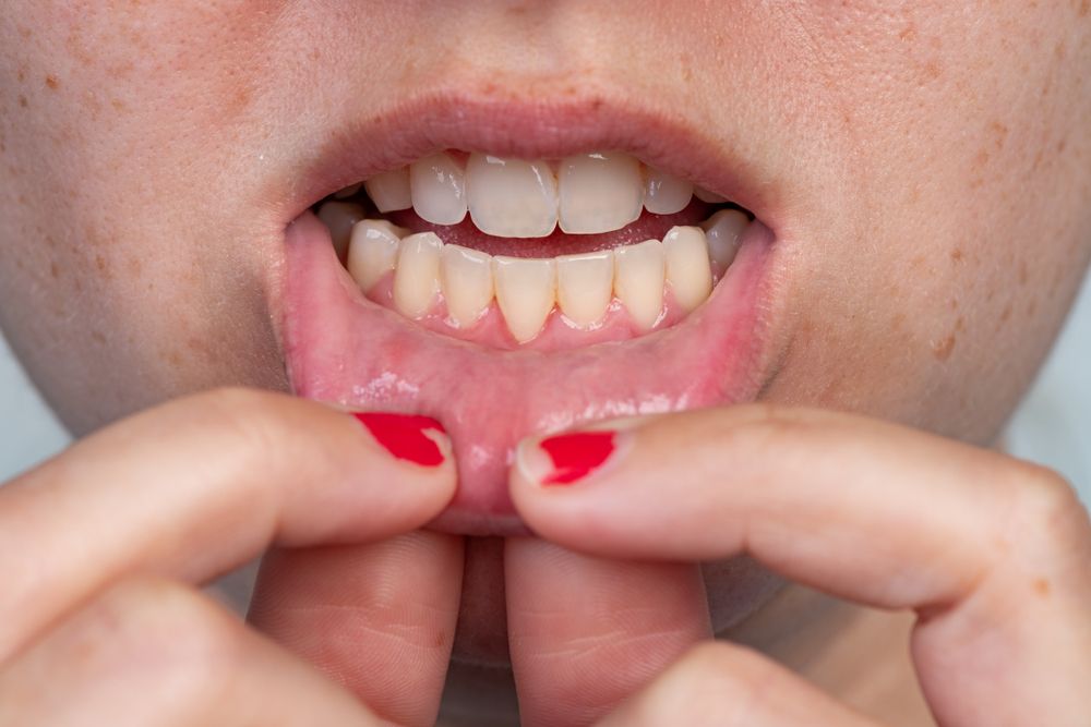 Gum Recession 101: Causes, Symptoms, and Treatment Options